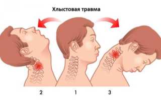 Хлыстовая травма шеи