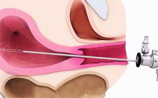 Когда приходит первая менструация после гистероскопии