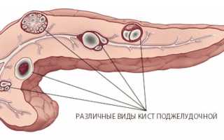 Кисты поджелудочной железы