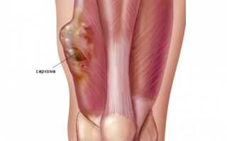 Синовиальная саркома: признаки, принципы лечения
