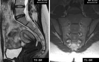 МРТ копчика