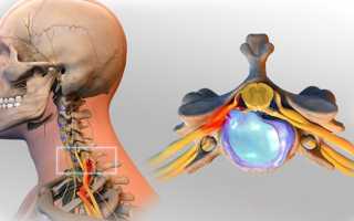 Рекомендации для пациентов с грыжей диска в шейном отделе позвоночника