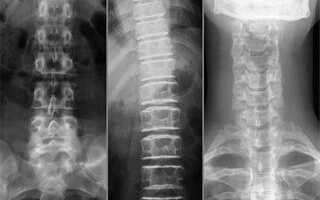 Рентген грудного отдела позвоночника