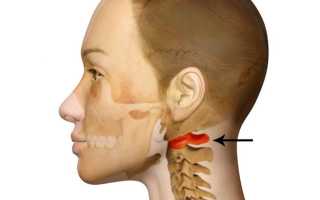 Подвывих шейного позвонка