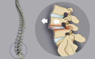 Смещение позвонков