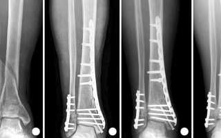 Перелом берцовых костей голени