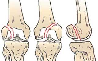 Перелом мыщелков большеберцовой кости