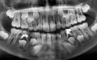 Рентген челюсти ребенка с молочными зубами