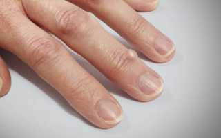 Лечение нароста на суставе пальца руки