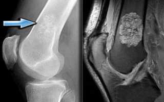Диагностика энхондромы конечностей на снимках МРТ и КТ