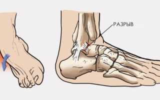 Повреждения межберцового синдесмоза