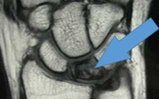 Остеохондропатия полулунной кости запястья