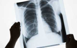 Нормальная рентгеноанатомия легких
