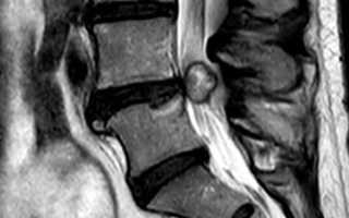 Киста позвоночника: классификация образования