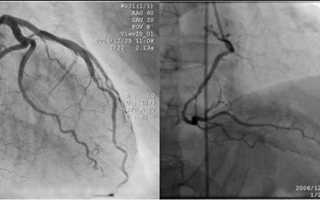 Коронарография, коронография сосудов сердца