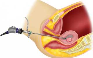 Могут ли быть осложнения после гистероскопии?