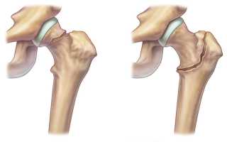 Перелом тазобедренного сустава