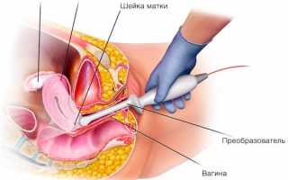 Как делают УЗИ малого таза
