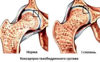 Лечение коксартроза 1 степени