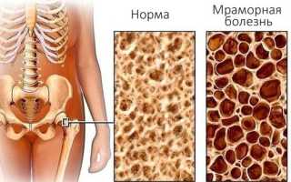 Остеопетроз (мраморная болезнь)