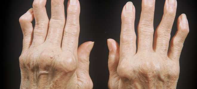 Как лечить артрит пальцев