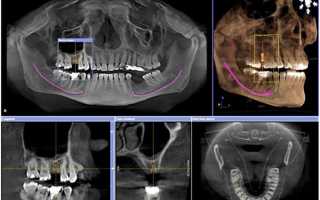 3d-снимок зубов: зачем нужно делать и что показывает