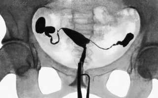 Зачем при планировании беременности назначают метросальпингографию (МСГ)